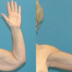 Lower Body Lift Mastopexy Augmentation Armlift And Thighlift - Before and After