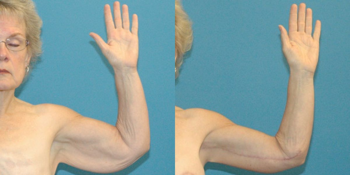 Lower Body Lift Mastopexy Augmentation Armlift And Thighlift - Before and After