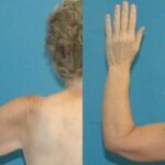 Lower Body Lift Mastopexy Augmentation Armlift And Thighlift - Before and After