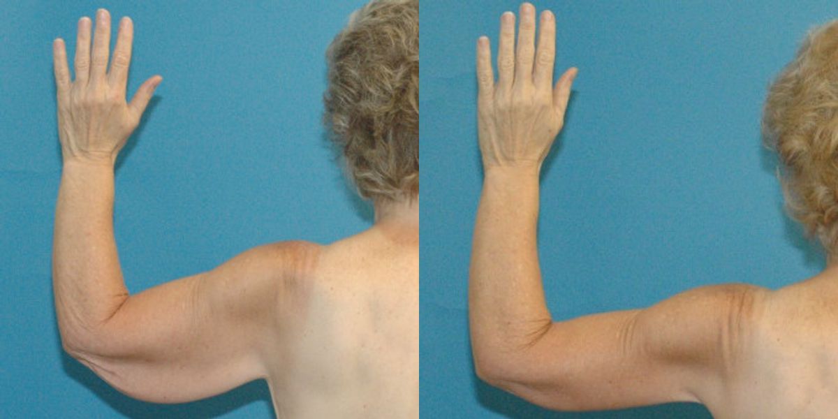 Lower Body Lift Mastopexy Augmentation Armlift And Thighlift - Before and After