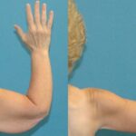 Lower Body Lift Mastopexy Augmentation Armlift And Thighlift - Before and After