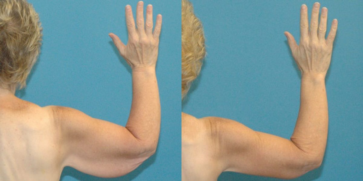 Lower Body Lift Mastopexy Augmentation Armlift And Thighlift - Before and After