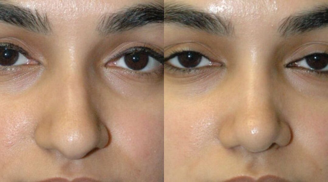Rhinoplasty #5