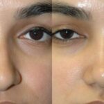 Rhinoplasty #5 - Before and After