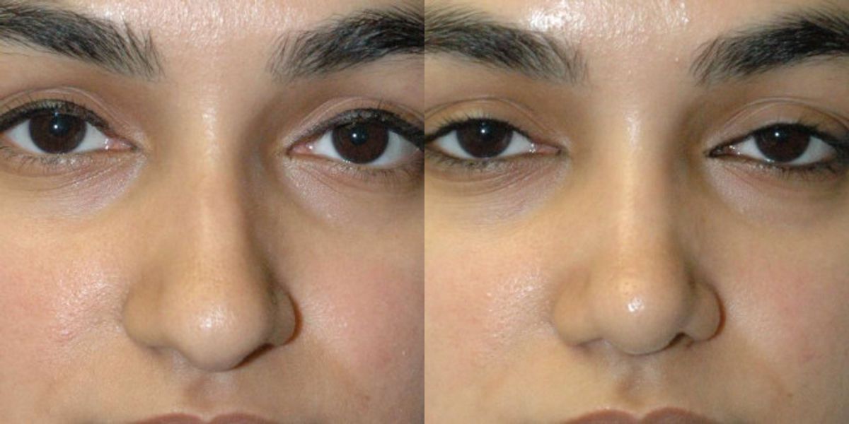 Rhinoplasty #5 - Before and After