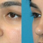 Rhinoplasty #5 - Before and After