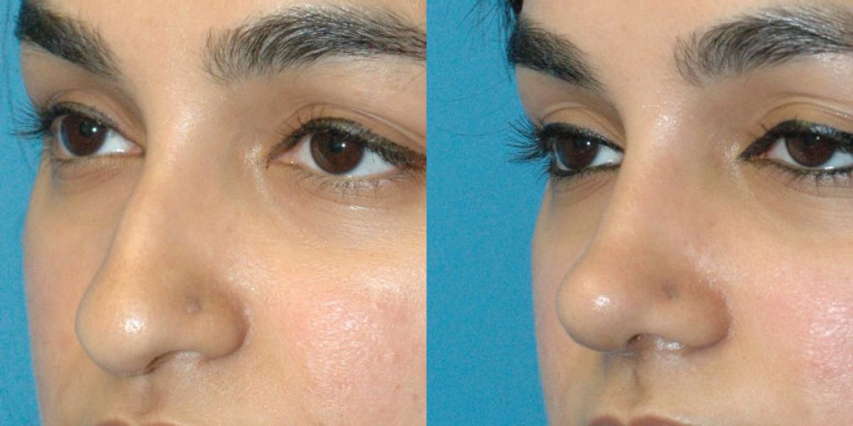 Rhinoplasty #5 - Before and After