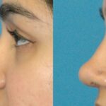 Rhinoplasty #5 - Before and After