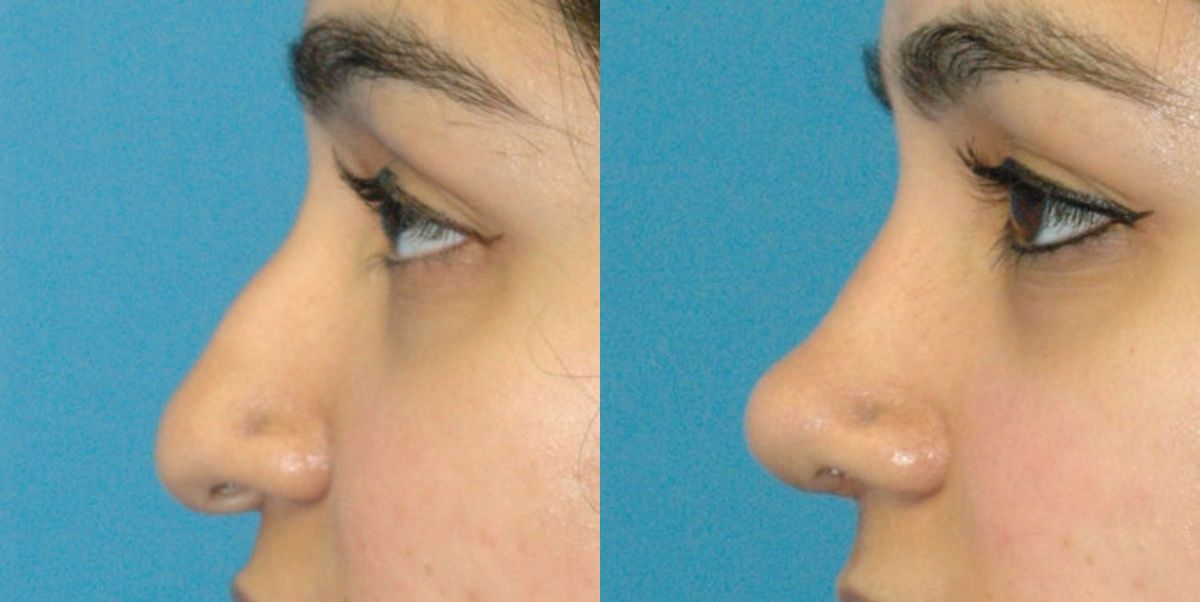 Rhinoplasty #5 - Before and After