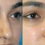 Rhinoplasty #5 - Before and After