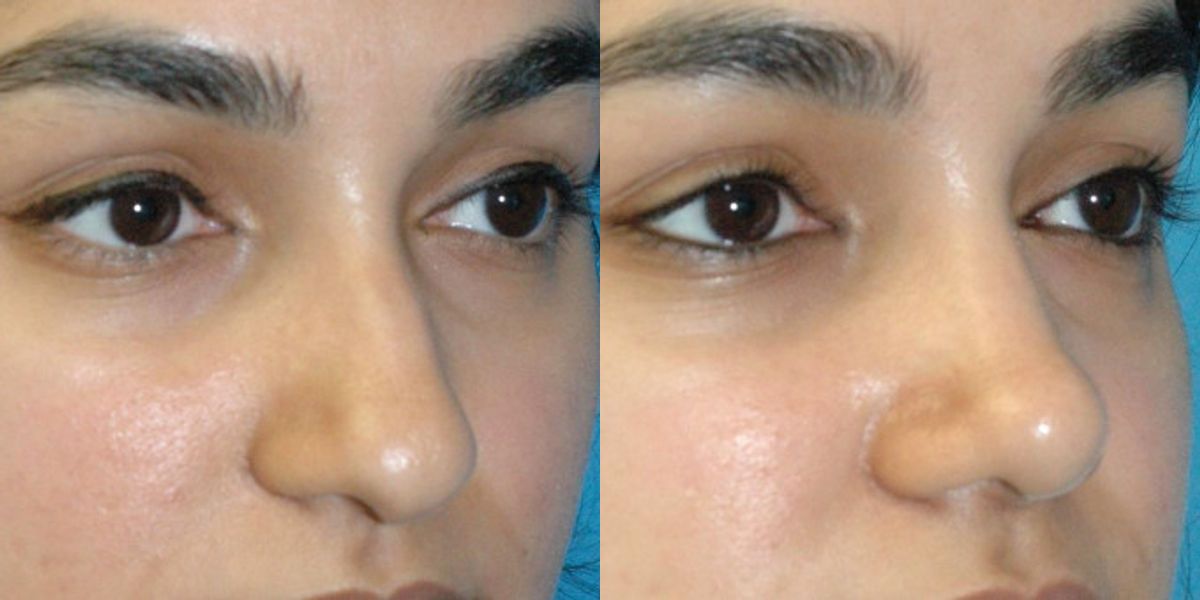 Rhinoplasty #5 - Before and After