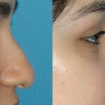 Rhinoplasty #5 - Before and After