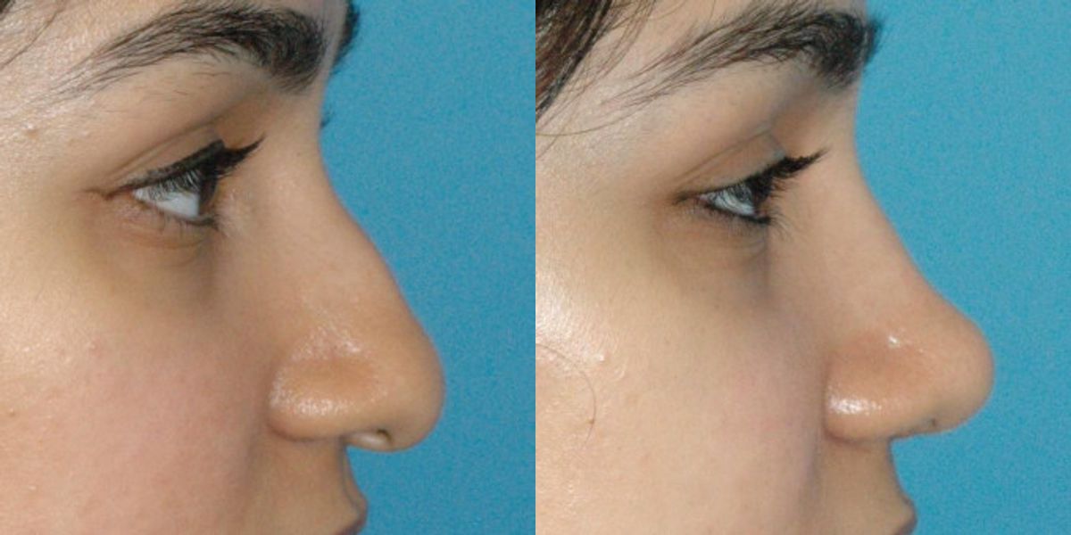 Rhinoplasty #5 - Before and After