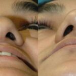 Rhinoplasty #5 - Before and After