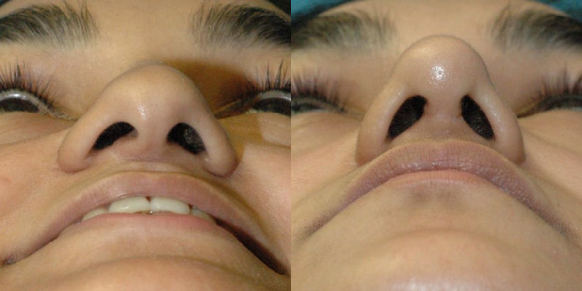 Rhinoplasty #5 - Before and After