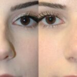 Rhinoplasty #6 - Before and After