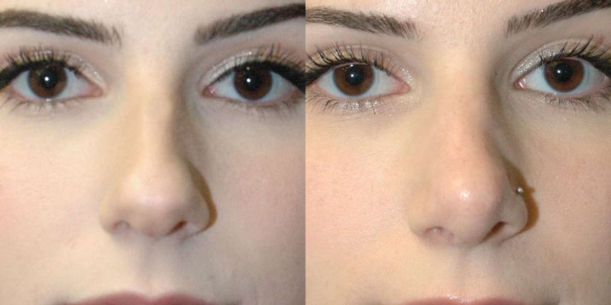 Rhinoplasty #6 - Before and After