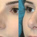 Rhinoplasty #6 - Before and After