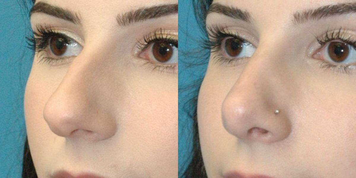 Rhinoplasty #6 - Before and After