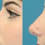 Rhinoplasty #6 - Before and After
