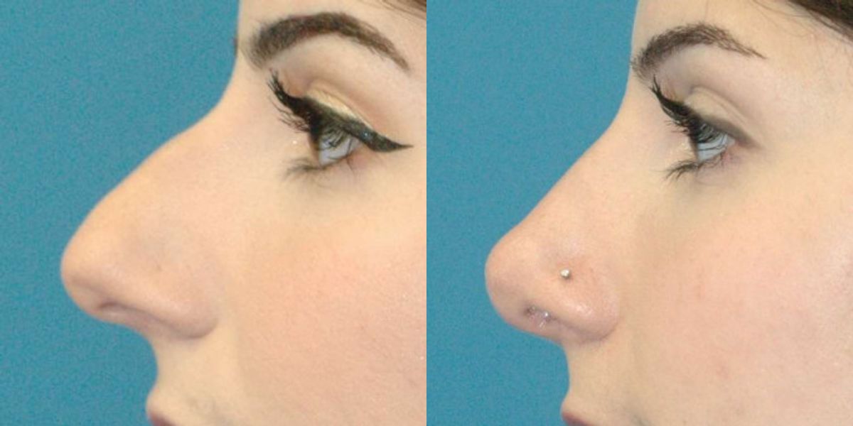 Rhinoplasty #6 - Before and After