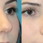 Rhinoplasty #6 - Before and After