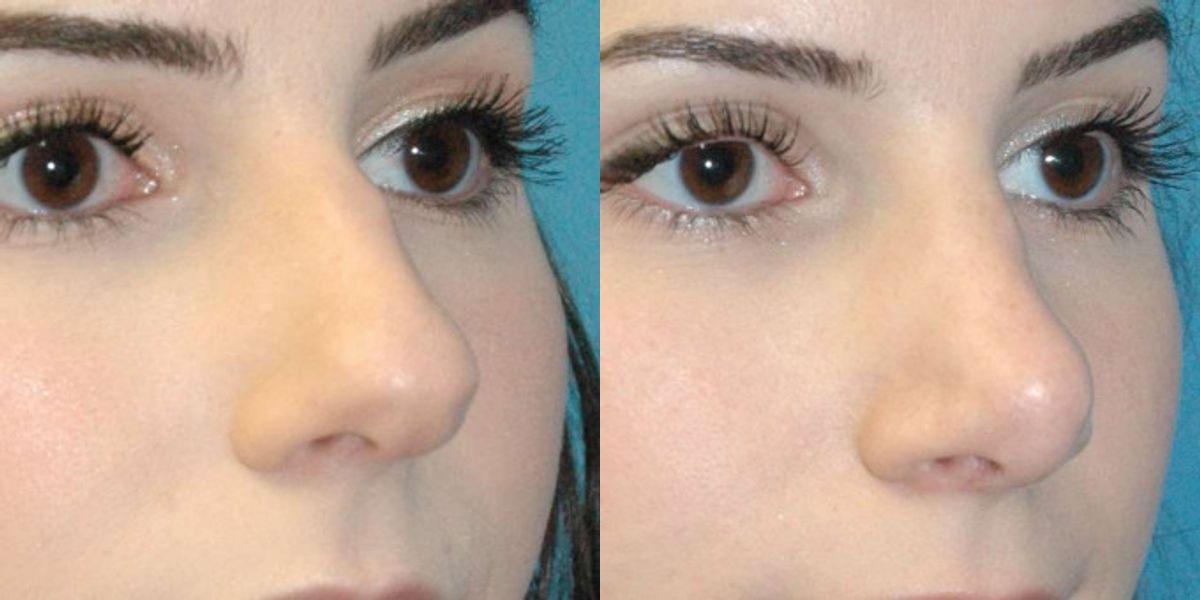 Rhinoplasty #6 - Before and After