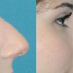 Rhinoplasty #6 - Before and After