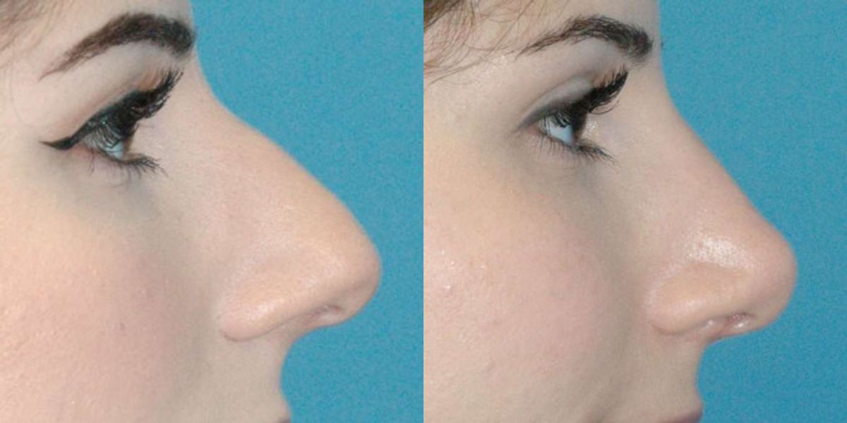 Rhinoplasty #6 - Before and After