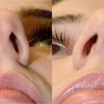 Rhinoplasty #6 - Before and After