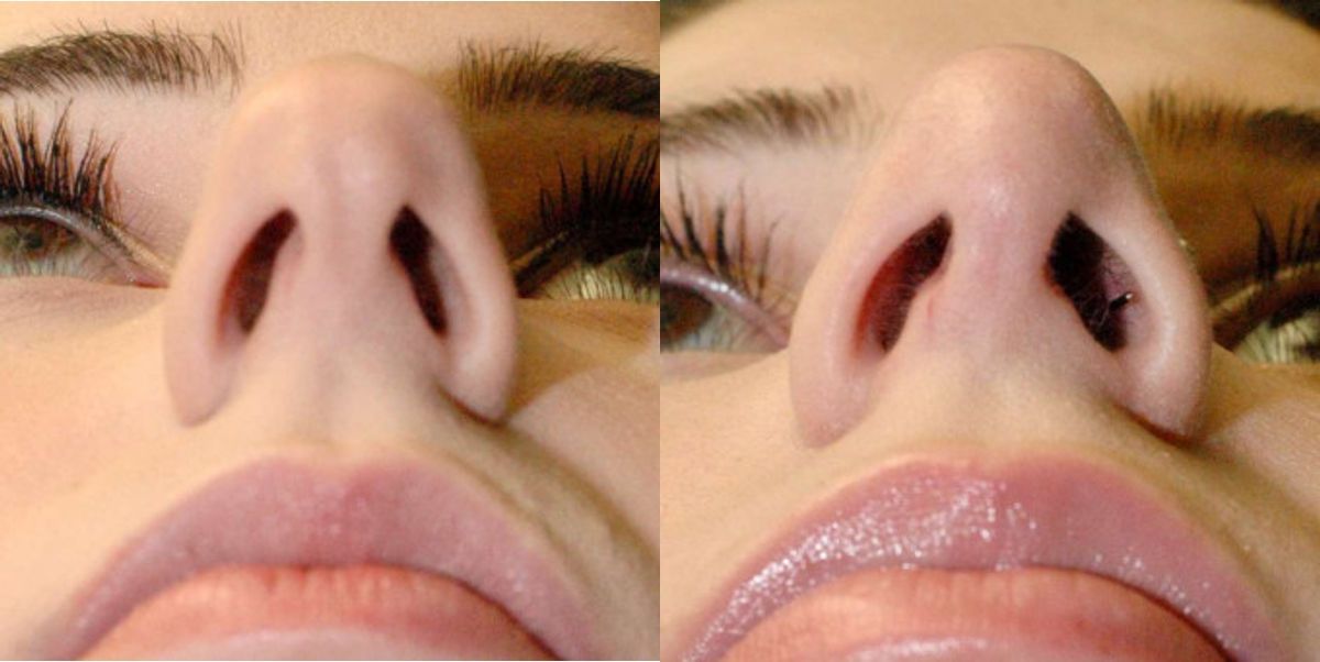Rhinoplasty #6 - Before and After