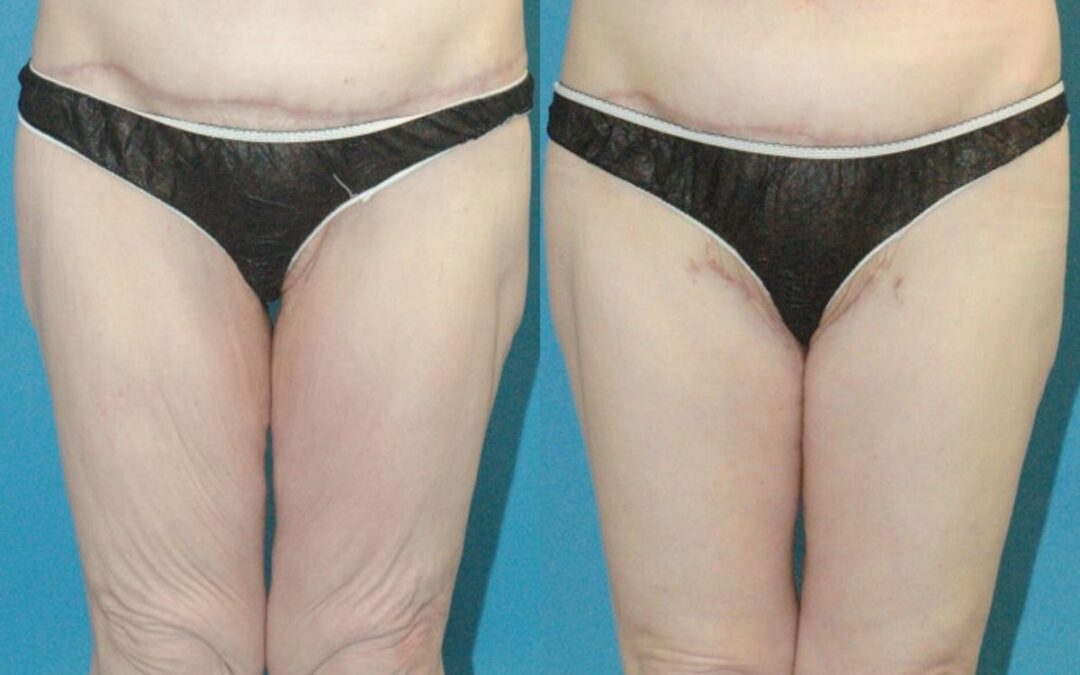 Thigh Lift #01