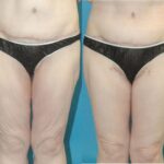 Thigh Lift #01 - Before and After