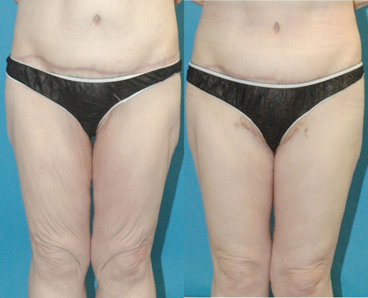 Thigh Lift #01 - Before and After