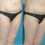 Thigh Lift #01 - Before and After