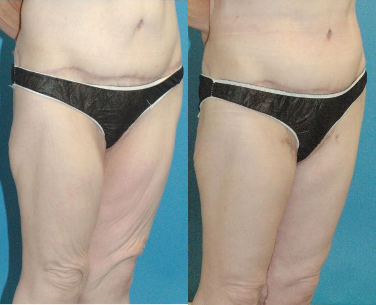 Thigh Lift #01 - Before and After