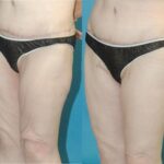Thigh Lift #01 - Before and After