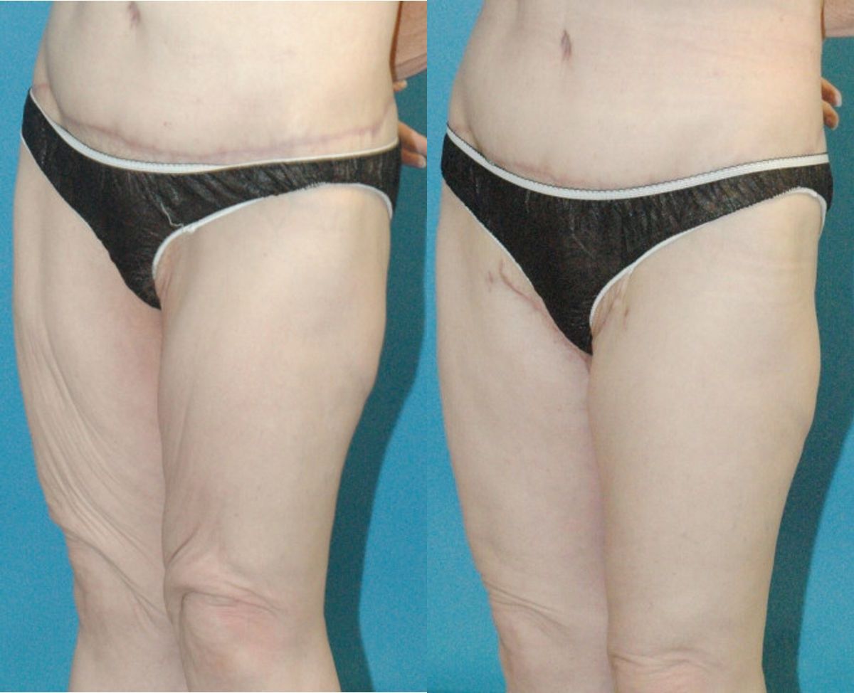 Thigh Lift #01 - Before and After