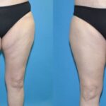 Thigh Lift #2 - Before and After