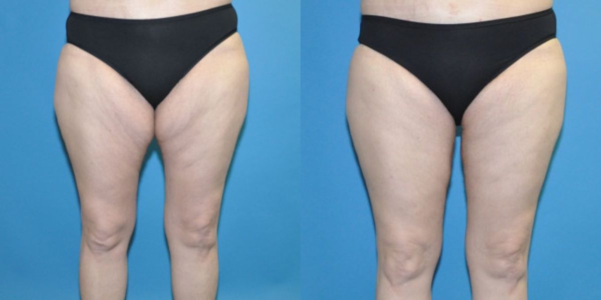 Thigh Lift #2 - Before and After