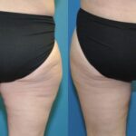 Thigh Lift #2 - Before and After