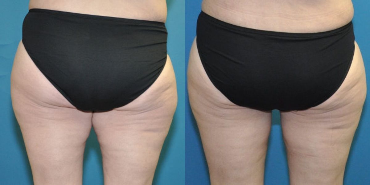 Thigh Lift #2 - Before and After