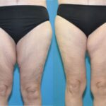 Thigh Lift #3 - Before and After