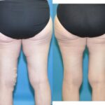Thigh Lift #3 - Before and After