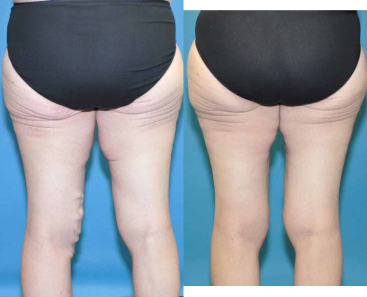 Thigh Lift #3 - Before and After