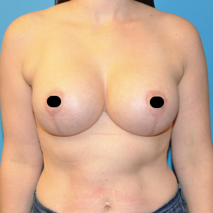 facial surgery after image