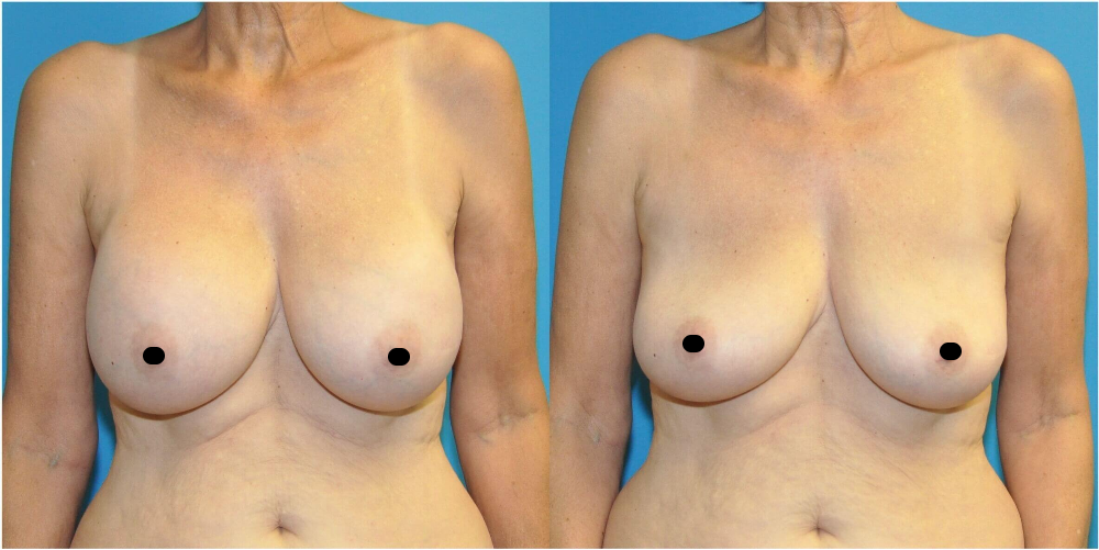 46bb0fe3-7df2-4a41-976d-6a96fcd973dc Before and after photo of a woman with breast implant removal
