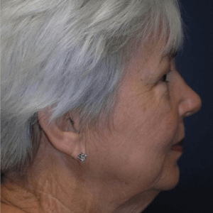 5e430b5492494 facial surgery before image