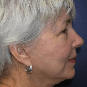 5e430b5eb8d9f facial surgery after image