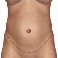 illustration of tummy tuck incision